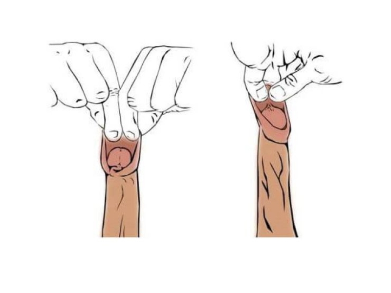 Dài bao quy đầu là gì?