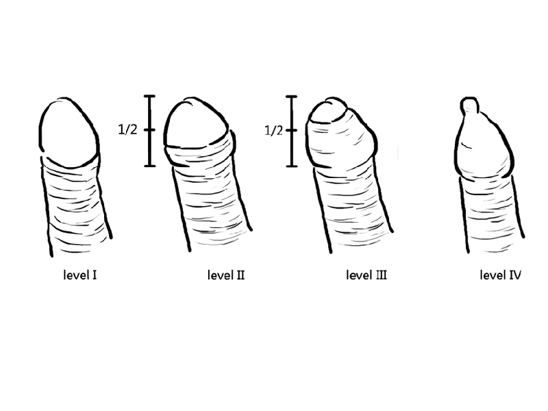 Dài bao quy đầu là gì?