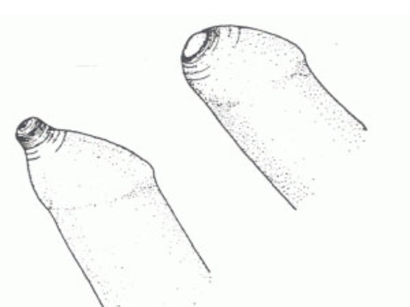 Dài bao quy đầu là gì?