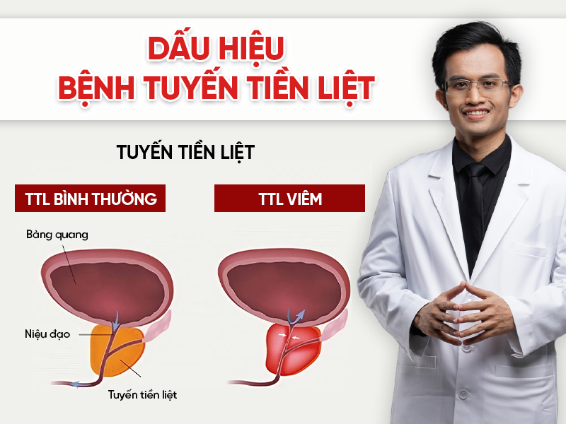 Dấu hiệu bệnh tuyến tiền liệt thường gặp: Khi nào cần đi khám?