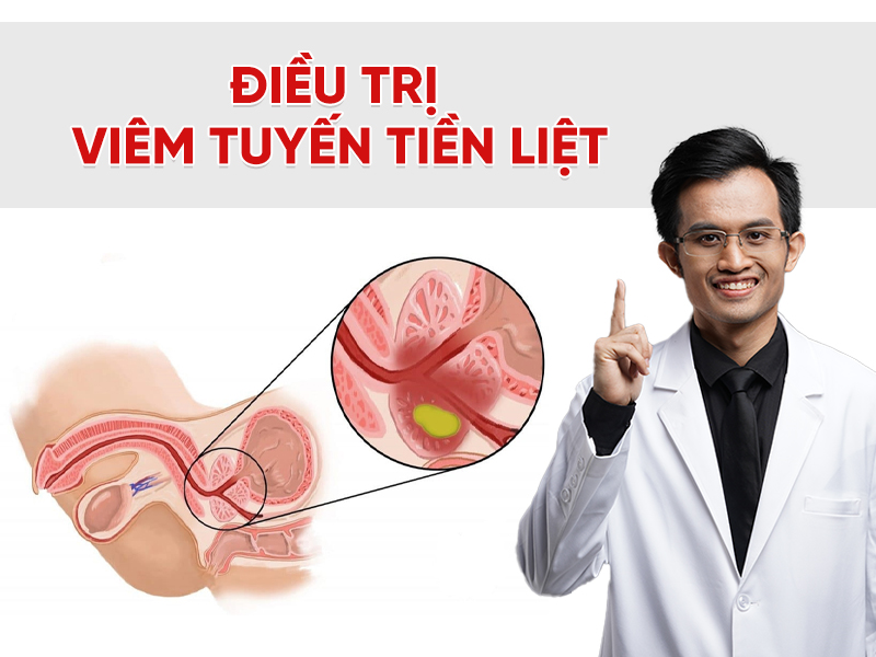 Điều trị viêm tuyến tiền liệt: Phác đồ, thuốc và các biện pháp hỗ trợ tại nhà
