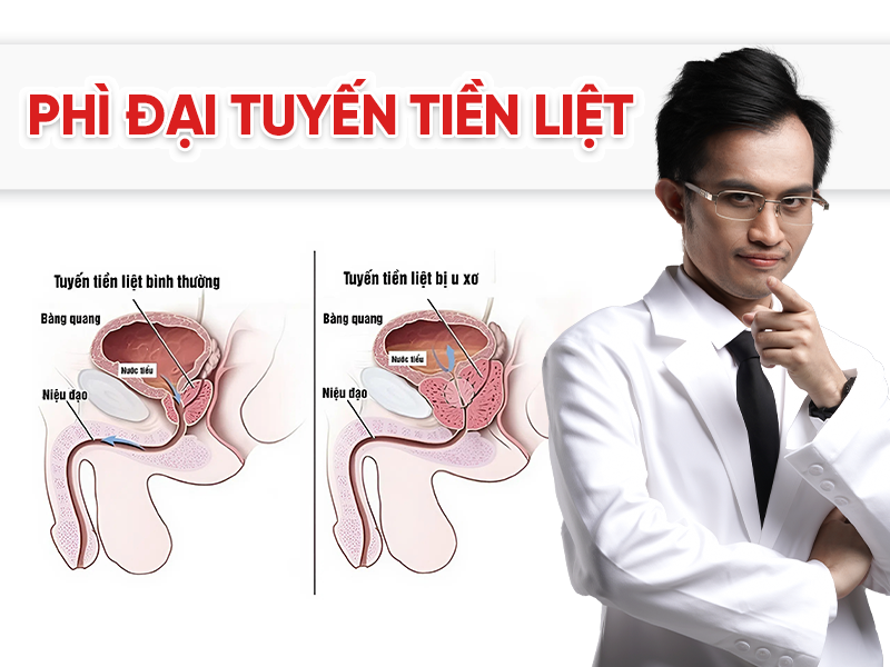 Phì đại tuyến tiền liệt: Dấu hiệu, mức độ nguy hiểm và cách khắc phục an toàn