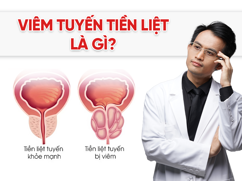 Viêm tuyến tiền liệt là gì? Nguyên nhân, triệu chứng và hướng điều trị hiệu quả