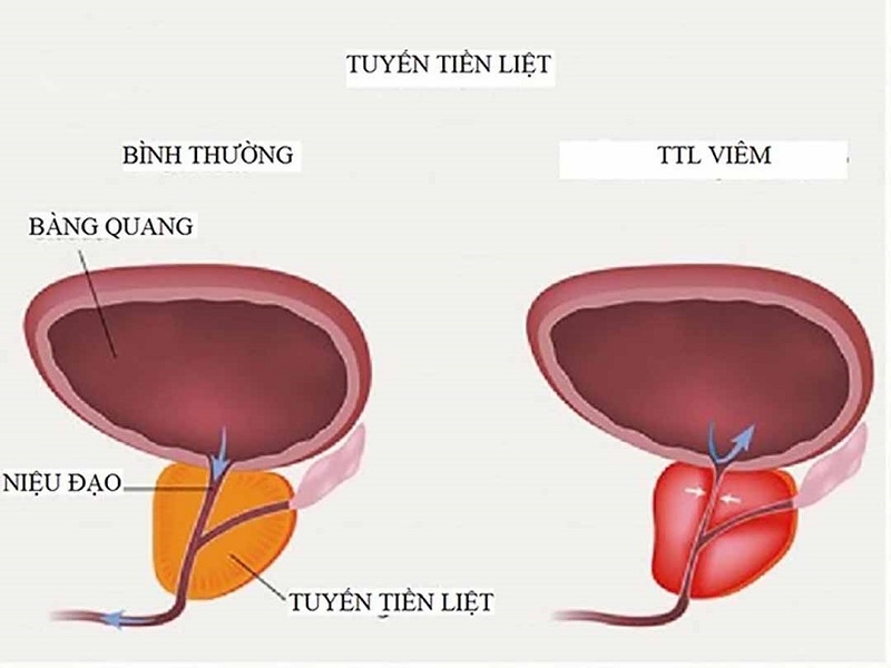 Viêm tuyến tiền liệt là gì?