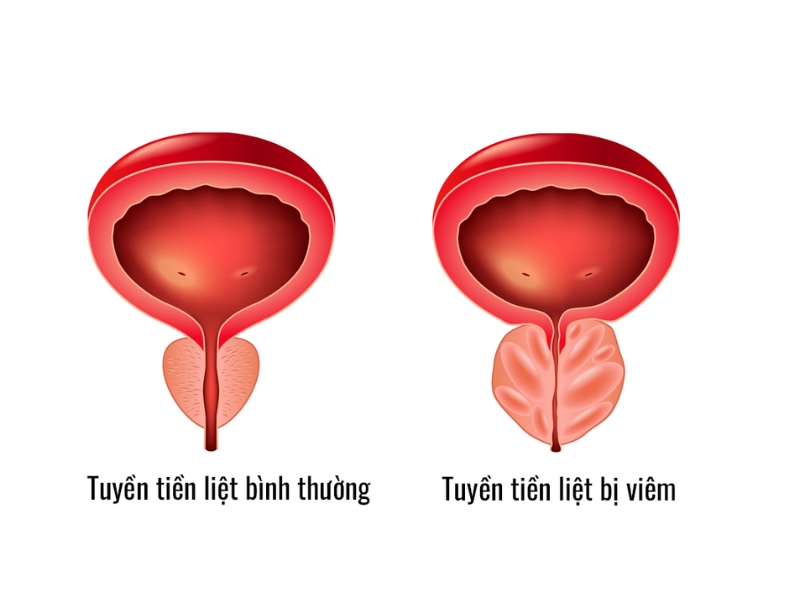 Viêm tuyến tiền liệt là gì?