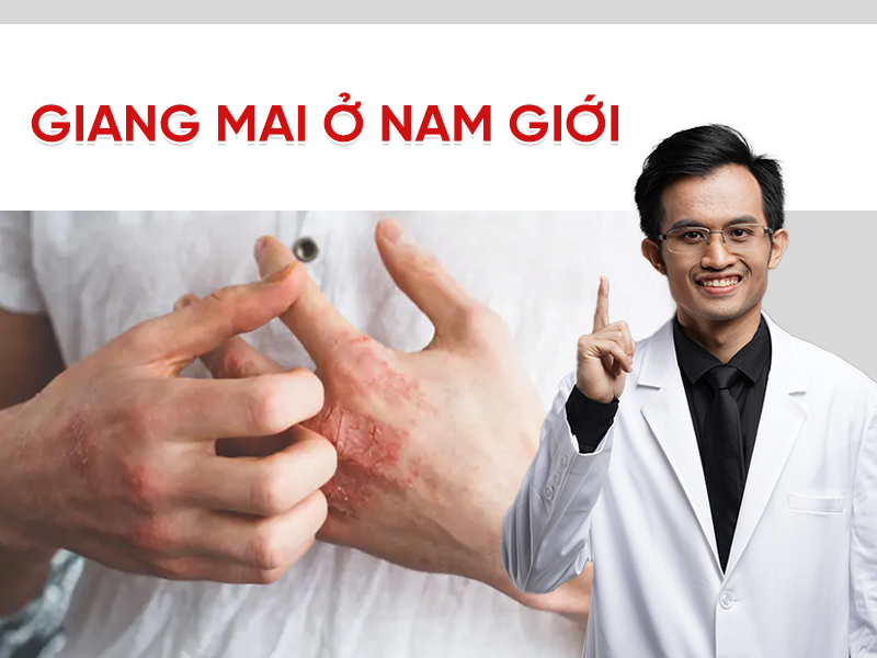 Giang mai ở nam giới: Triệu chứng theo từng giai đoạn và cách điều trị