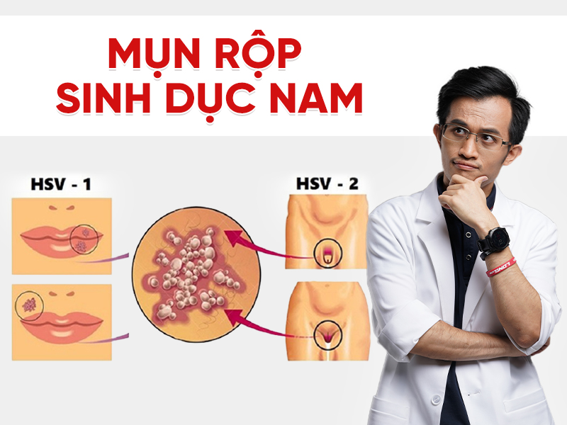 Mụn rộp sinh dục nam: Nguyên nhân, dấu hiệu và cách điều trị dứt điểm
